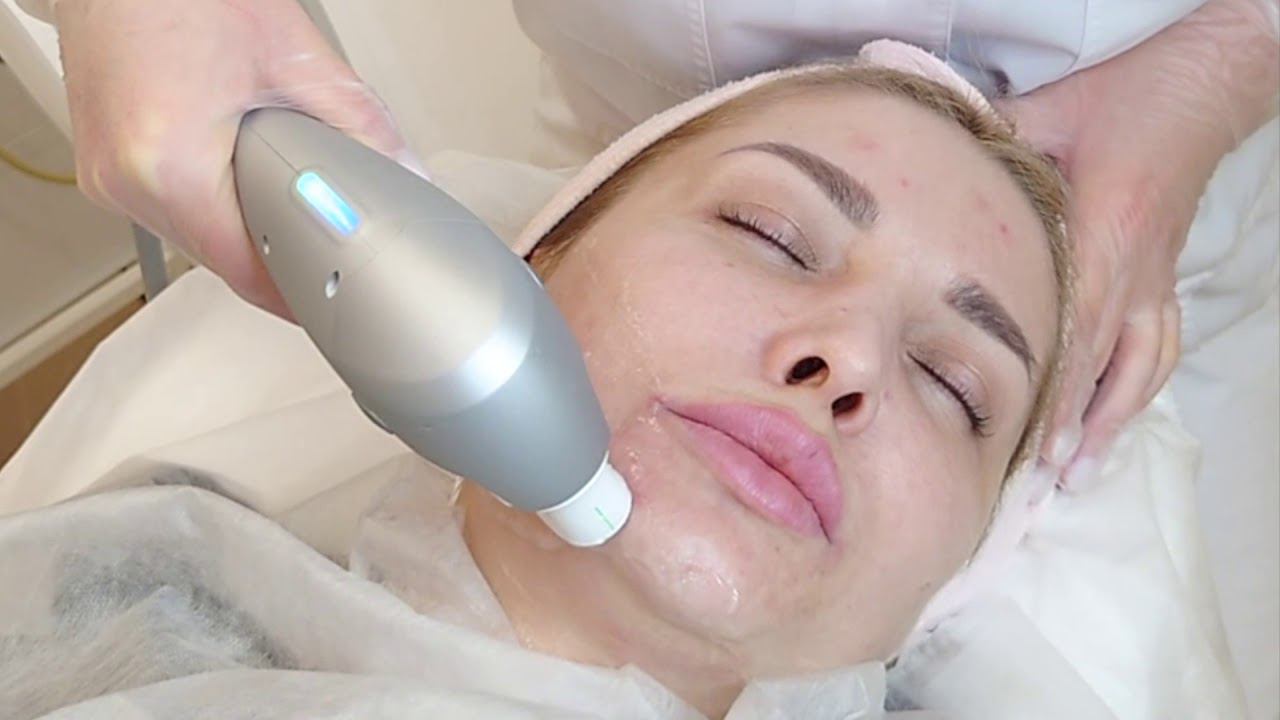 Ультраформер - убираем подбородок, подтяжка нижней трети лица смотреть онлайн