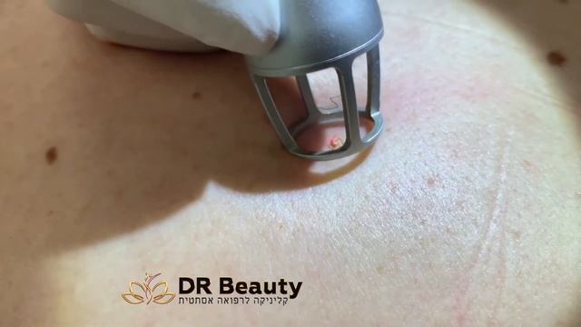 Удаление родинок лазером CO2 в Израиле Dr Beauty смотреть онлайн