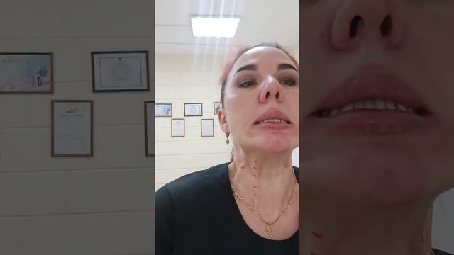 С чего нужно начинать, чтобы не было брылей! Или как ботокс поможет сформировать овал лица! смотреть онлайн