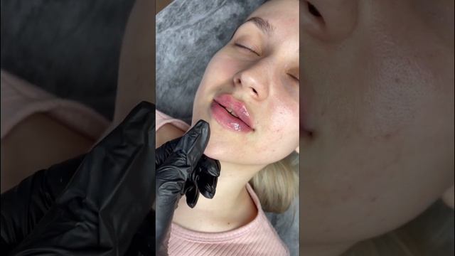 #shorts #контурнаяпластикагуб #косметология #плоскийбант #увеличениегуб #губы #контурнаяпластика