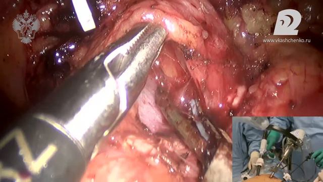 Gastric Surgery School 2014. 3D laparoscopic distal gastrectomy. Full video. смотреть онлайн