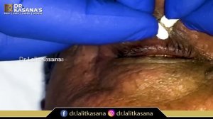 Blackheads Rmoval by Dr. Lalit Kasana's