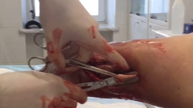 Вскрытие гнилостной флегмоны плеча смотреть онлайн