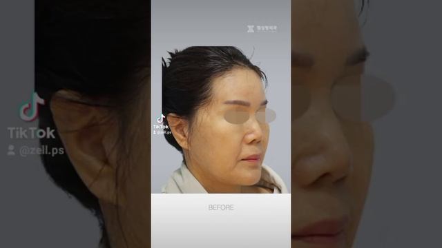 얼굴이 반쪽 되는 마법? - 안면거상 목거상 얼굴지방재배치 코재수술 구축코교정 #shorts смотреть онлайн