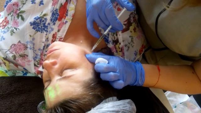 Мезотерапия. Разметка. Как сделать мезотерапию.