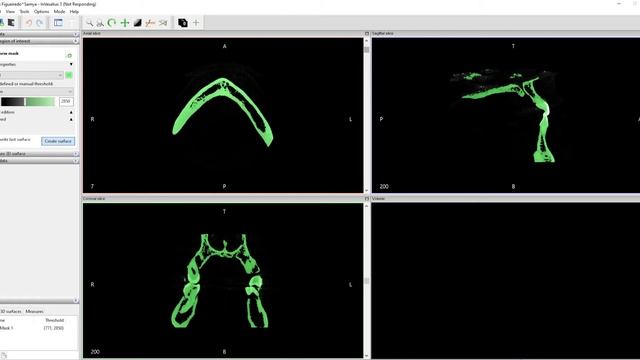 Tutorial: Creating an STL file from your CBCT DICOM files using Invesalius смотреть онлайн