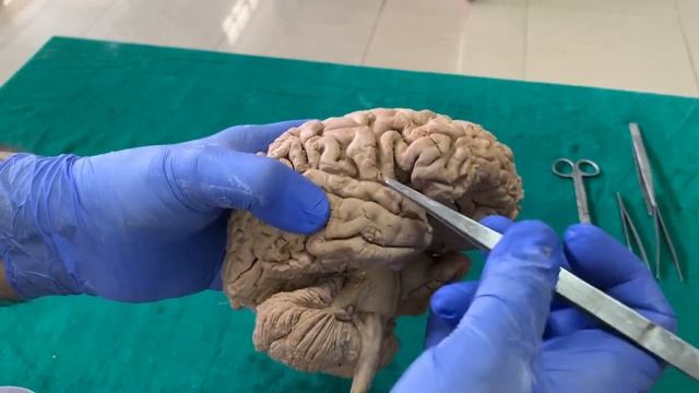 Dissection - Sulci & Gyri of Superolateral surface of brain смотреть онлайн