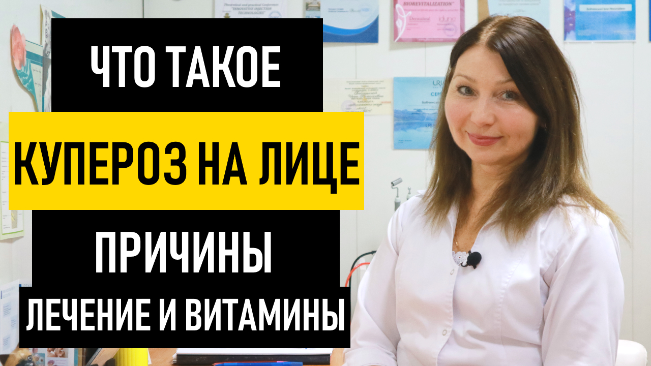 Лечение Купероза на ЛИЦЕ в домашних условиях. Как убрать сосудистые звездочки на лице и теле смотреть онлайн