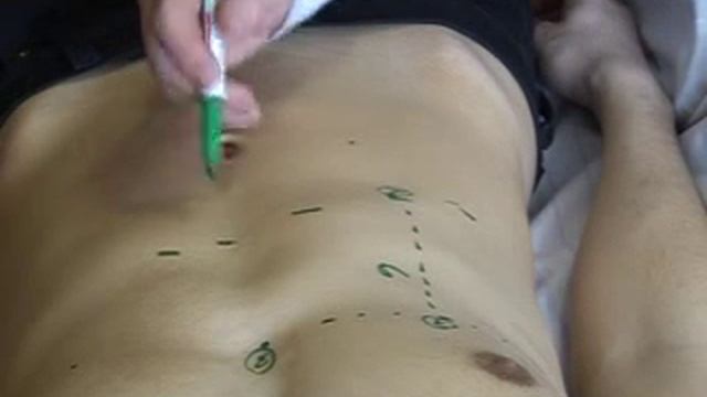 Percussion of Liver Dullness (Kurlov's method)- VSMU смотреть онлайн