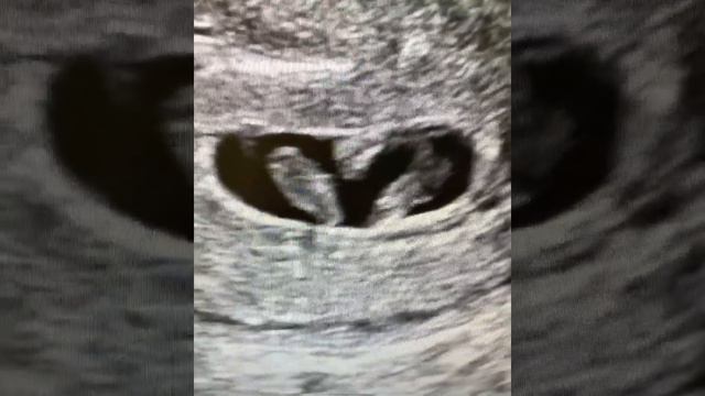 Криоперенос двух эмбрионов Но, на экране мы видим только одно плодное яйцо. Но, в нем два эмбриона смотреть онлайн