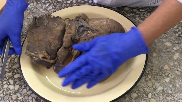 Печень. Поджелудочная железа. Желчный пузырь.Hepar. Pancreas. Vesica fellea. смотреть онлайн