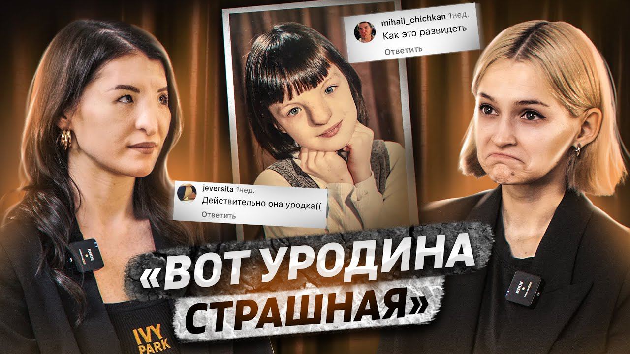 Девочка с носом Аватара | Гипертелоризм II степени смотреть онлайн