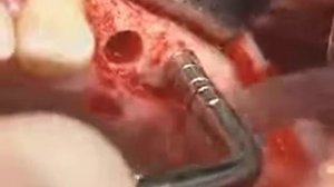 Установка зубного импланта - полное видео