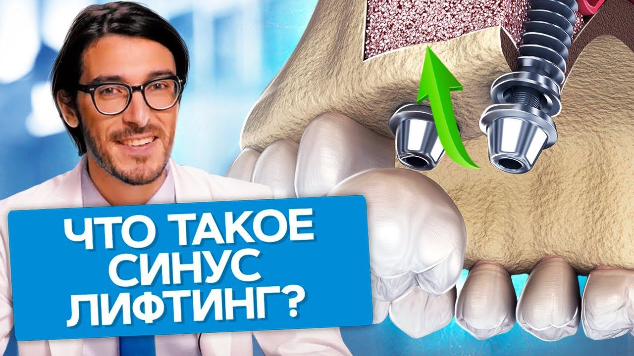 Что такое синус лифтинг? Что нужно знать о синус лифтинге и какие последствия ждут пациента? смотреть онлайн