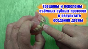 ЗУБНЫЕ ПРОТЕЗЫ. Трещины и переломы съёмных зубных протезов в результате оседания десны.mp4