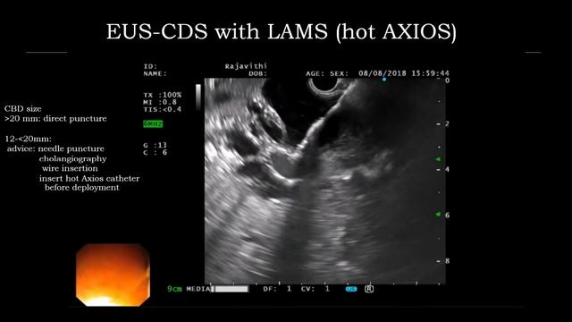 EUS Series 5 Biliary Drainage English version смотреть онлайн