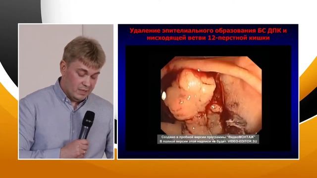 1 Селезнев ДЕ Эндоскопическое удаление крупного новообразования БДС с распространением на стенку ДП смотреть онлайн