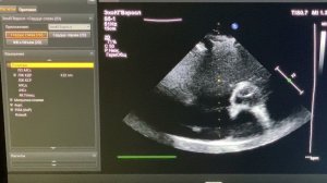 Практическое занятие. ЭхоКГ после протезирования митрального клапана. О.Л. Ерошенко.