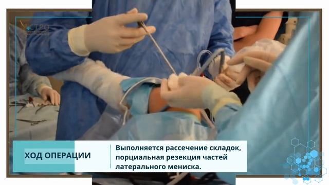 Артроскопия коленного сустава
