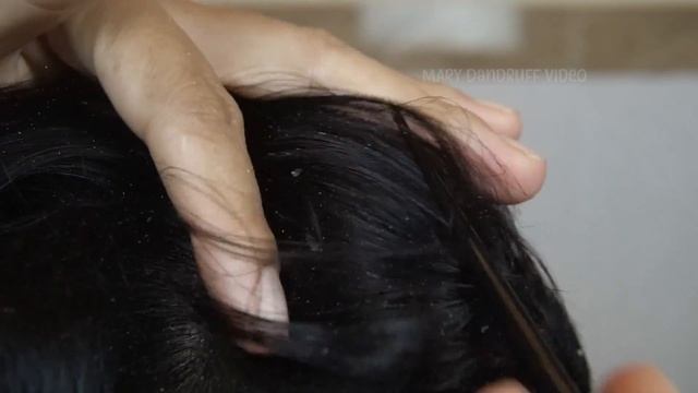 Удаление перхоти с больших хлопьев кожи головы #895 смотреть онлайн