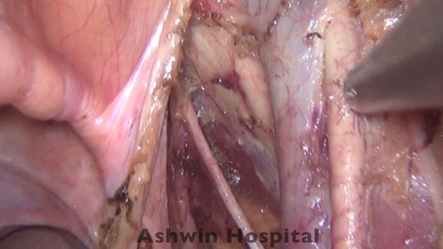 Laparoscopic Pelvic Lymph Node Dissection in a male смотреть онлайн