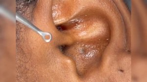 Blackheads extraction | выдавливание чёрных точек из ушей