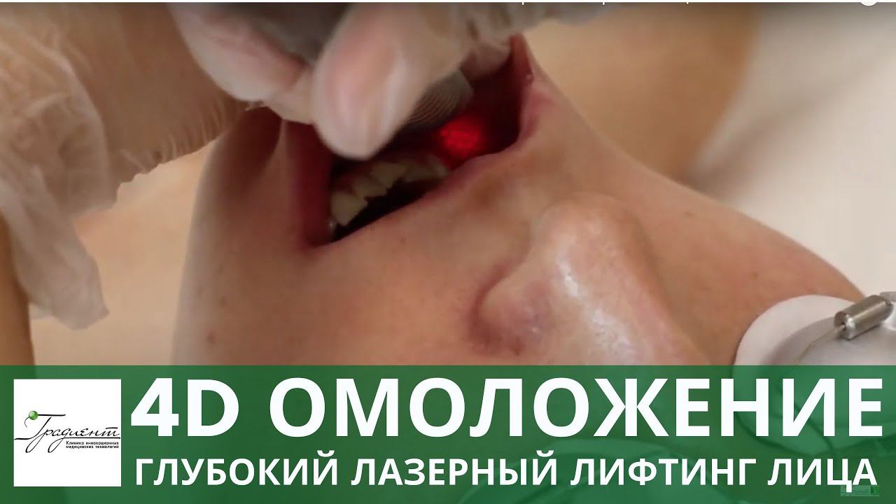 ЛАЗЕРНОЕ ОМОЛОЖЕНИЕ 4D FOTONA - безоперационный лифтинг лица смотреть онлайн