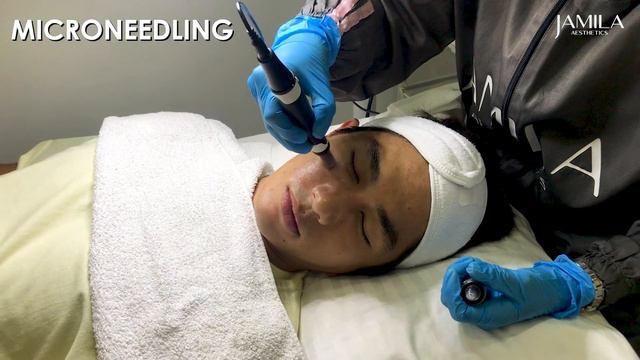 Acne Treatment for Hashtag Nikko