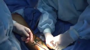 Флебэктомия