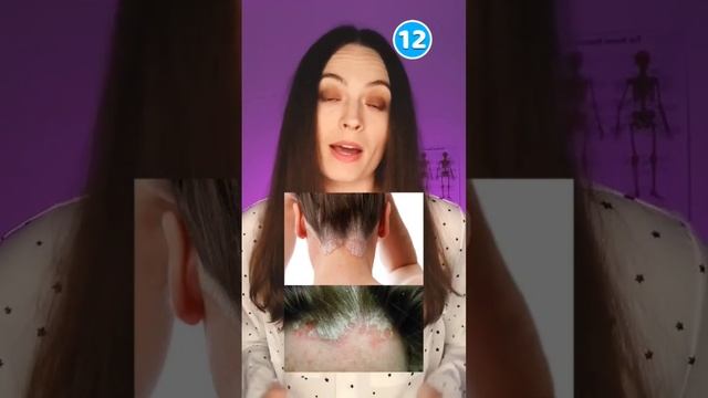 Что такое псориаз?