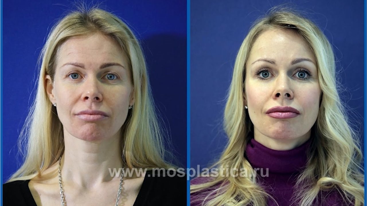 Эндоскопический лифтинг лба от Алексея Гварамии: Омоложение лица (до и после) смотреть онлайн