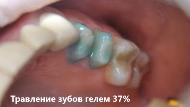 фиксация коронок EMAX смотреть онлайн