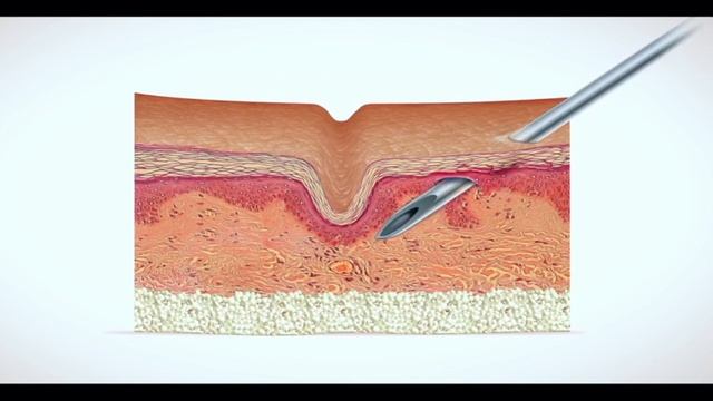 Как действуют филлеры смотреть онлайн