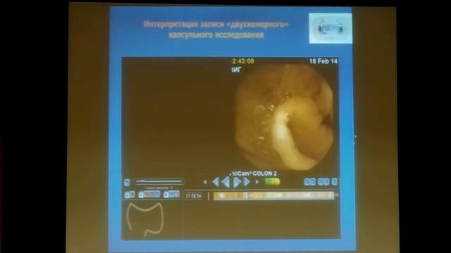 12 Иванова Е В Капсульная колоноскопия новая диагностическая методика смотреть онлайн