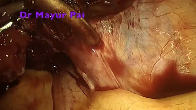laparoscopic hysterectomy | endometriosis | tubo ovarian mass | pelvic infection смотреть онлайн