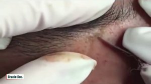 Выдавливание черных точек и прыщей #4