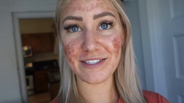 Chemical Peel On Sensitive Skin (NEVER AGAIN!!!) смотреть онлайн