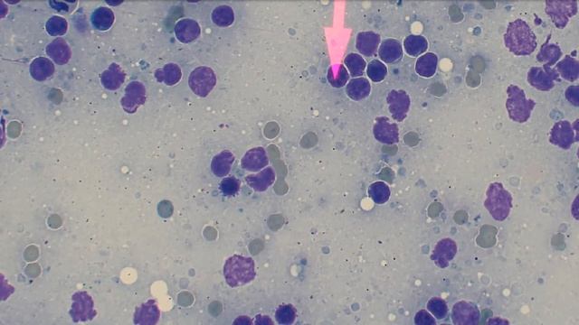 5 Minute Rounds: Metastatic carcinoma смотреть онлайн