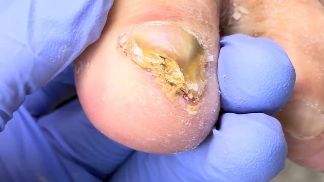 Very thick onychomycosis, yellow nails curling downward【Doctor Liu Pedicure】 смотреть онлайн