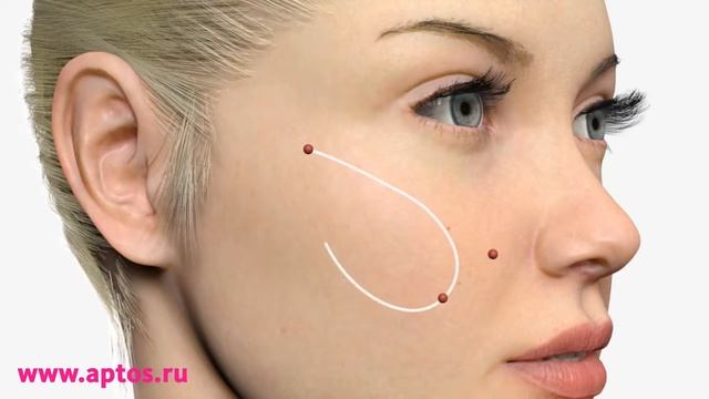 Нитевой лифтинг Аптос в Евро-Шарм: нити с насечками смотреть онлайн