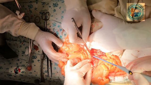 OPEN SIGMOID RESECTION, D3, PRESERV. LCA SRA/резекция сигмовидной кишки Д3, сохранение ЛОА и ВПА. смотреть онлайн