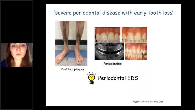 Fransiska Malfait - The Rarest Types of EDS смотреть онлайн