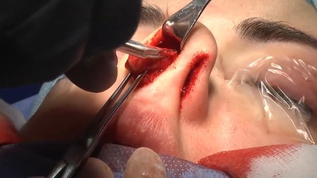 Ринопластика. Компаниец Олег