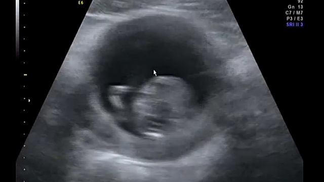 Двойня. Скрининг первого триместра беременности. 3D узи. смотреть онлайн