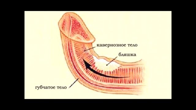 Болезнь Пейрони