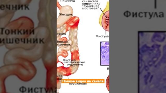 14 Признаков того, что Толстая КИШКА ОТМИРАЕТ смотреть онлайн