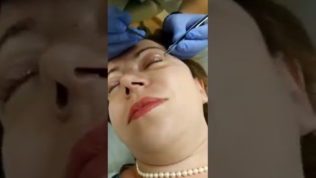 Блефаропластика снятие швов смотреть онлайн
