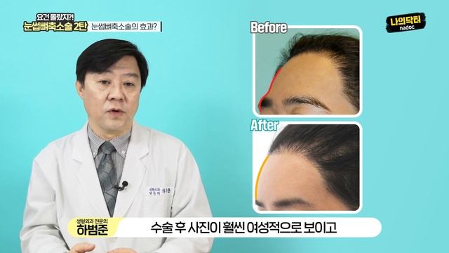 눈썹뼈축소술 2탄! 울퉁불퉁 이마라인, 튀어나온 눈썹뼈가 문제였다! 지방이식, 보형물 삽입으로 안 되는 문제가 있는 이마를 해결하는 눈썹뼈축소술! - 닥터 하범준