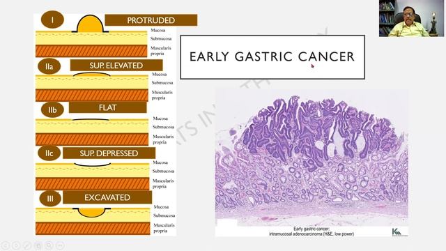 RRR Gastric Cancer | GIT | R.A.T.S in Pathology | Dr G Shivashekar | UQs/ specimens/slides. смотреть онлайн
