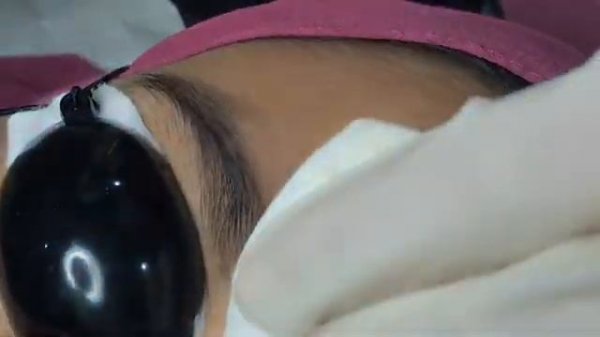NSC Eyebrow Laser hair Removal